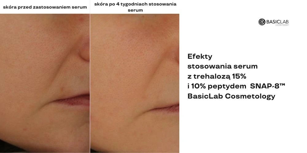 kosmetyki na bruzdy nosowo-wargowe efekty
