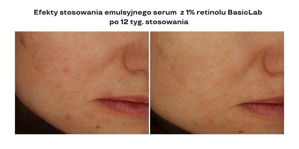 serum z retinolem efekty stosowania