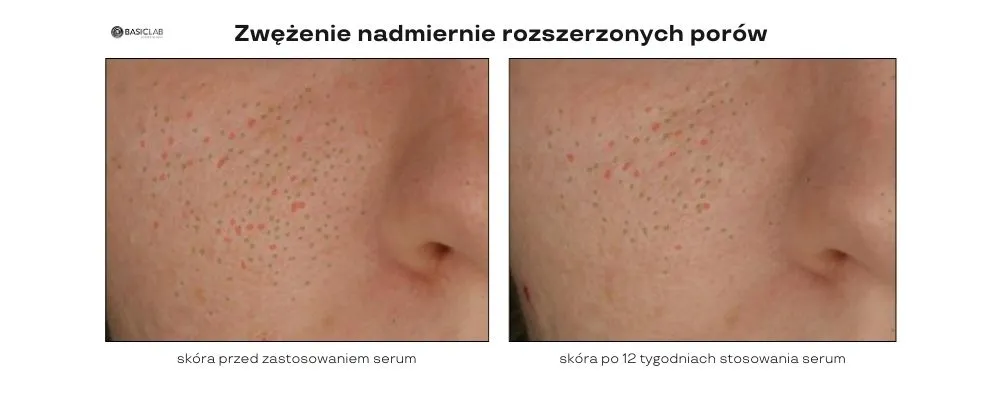 niacynamid na rozszerzone pory