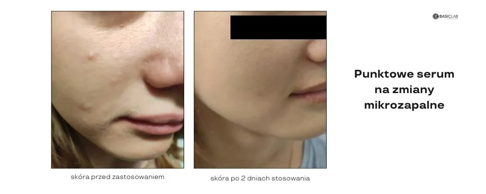 poprawa kondycji skóry trądzikowej efekty