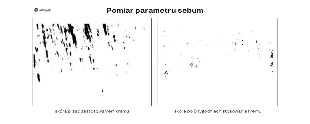 efekty krem do skóry trądzikowej