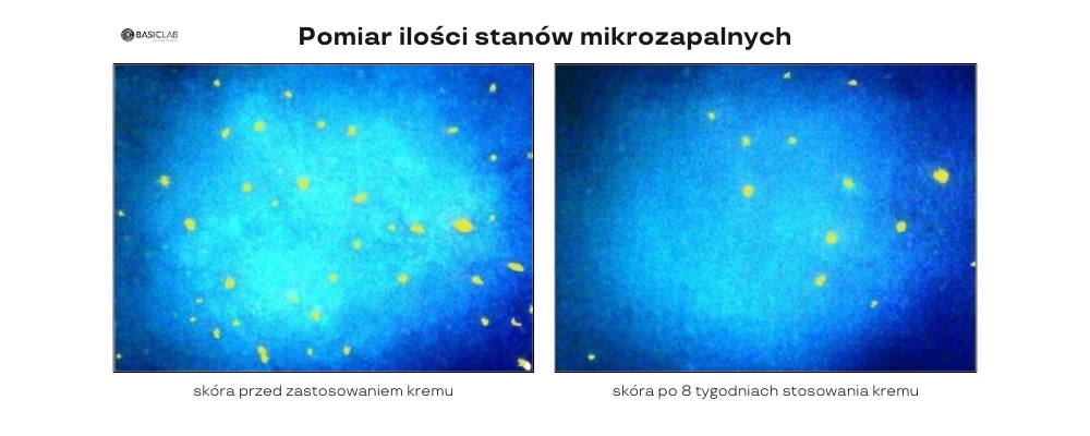 efekty na trądzik krem prebiotyczny BasicLab