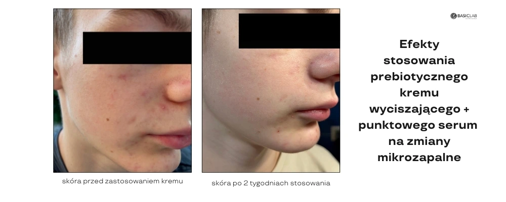 prebiotyczny krem wyciszający efekty stosowania