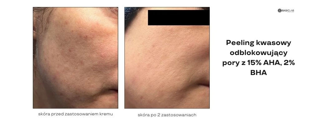 peeling kwasowy efekty pielęgnacji