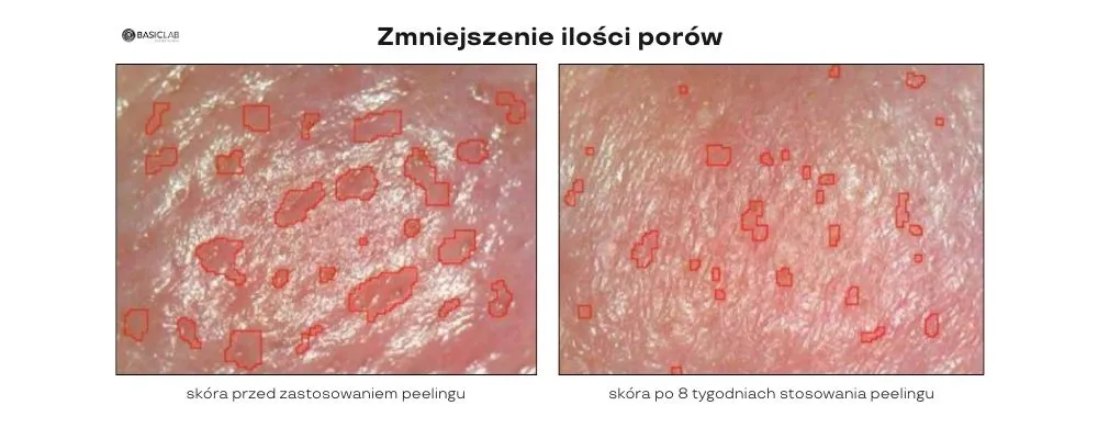 zmniejszenie ilości porów peeling odblokowujący pory