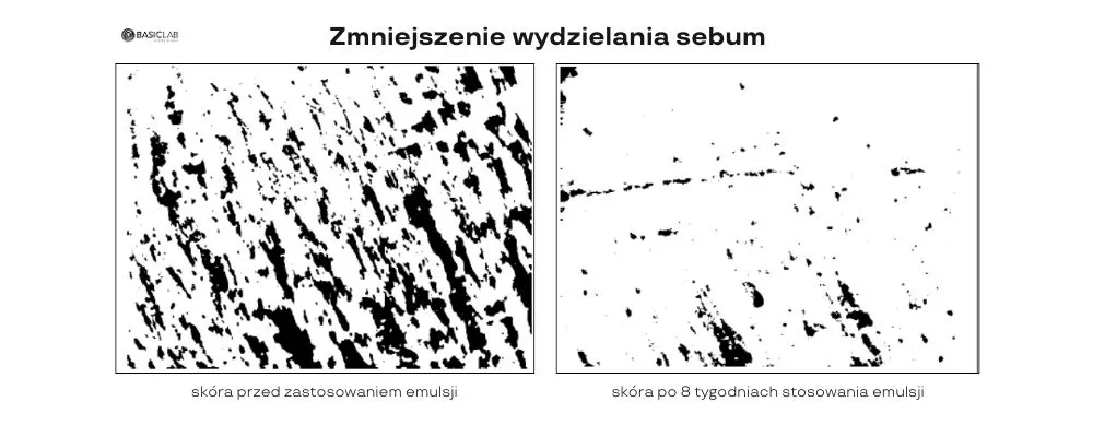 zmniejszenie wydzielania sebum emulsja normalizująca lekka