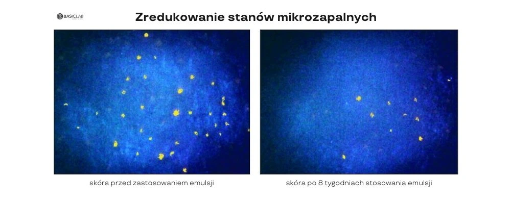 zmniejszenie ilości zmian trądzikowych lekka emulsja normalizująca